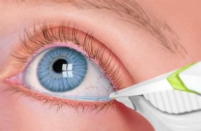 tear lab maximun testing per patient per year|tearlab dry eye test positive.